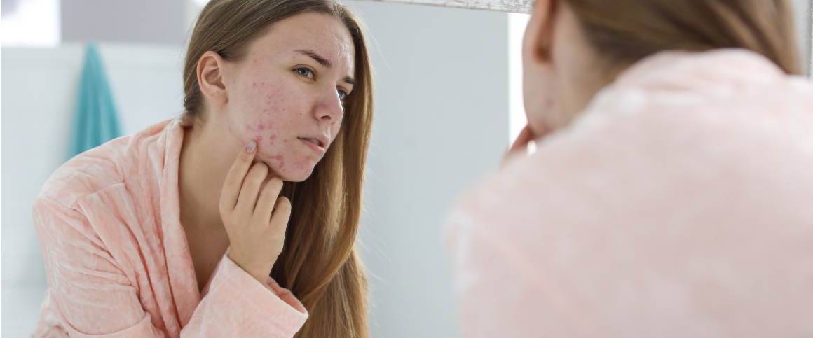 does-acne-come-back-after-doxycycline